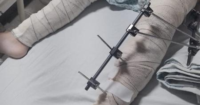 Menina de 6 anos cai da bicicleta e tem pinos colocados em perna errada no hospital
