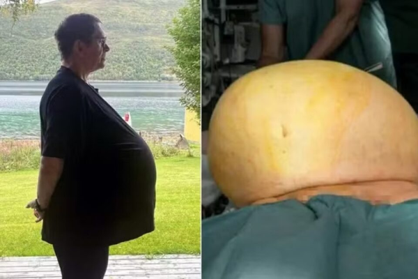 Médico descobre que homem tratado com Ozempic tinha na verdade um tumor de 27kg na barriga