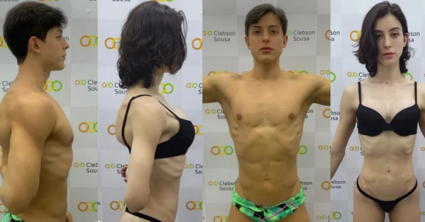 Veja o antes e depois do procedimento nos glúteos de Bella Longuinho